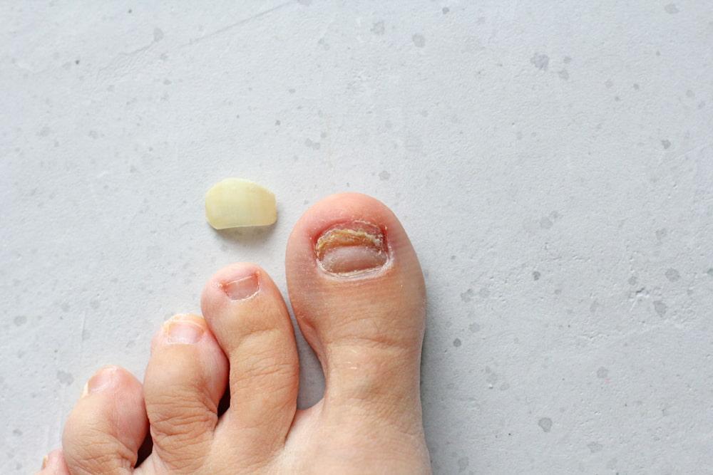How to Know If Toenail Fungus Is Dying