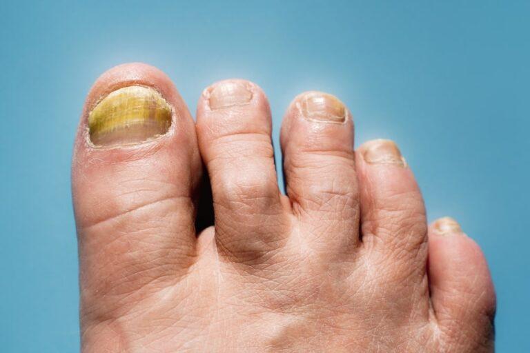 How to Know if Toenail Fungus is Dying (2023) | PureHealth Research