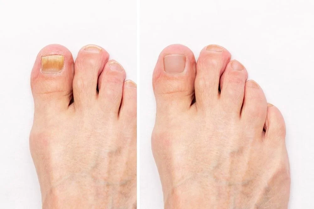 Comparison of color changes in toenail fungus