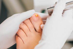 A Person Treating Their Foot With One of the Best Ways to Get Rid of Toenail Fungus
