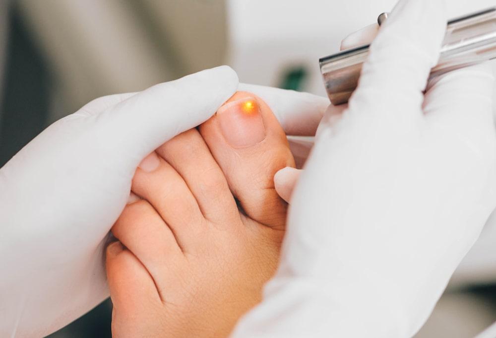 A Person Treating Their Foot With One of the Best Ways to Get Rid of Toenail Fungus