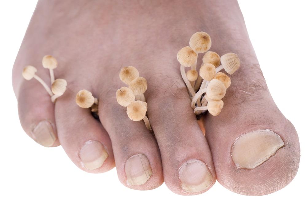 Can Your Nail Fungus Spread