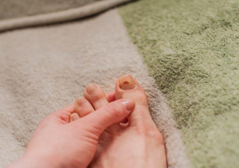 EarlyStage of Toenail Fungus Symptoms, Causes and Treatments (2023