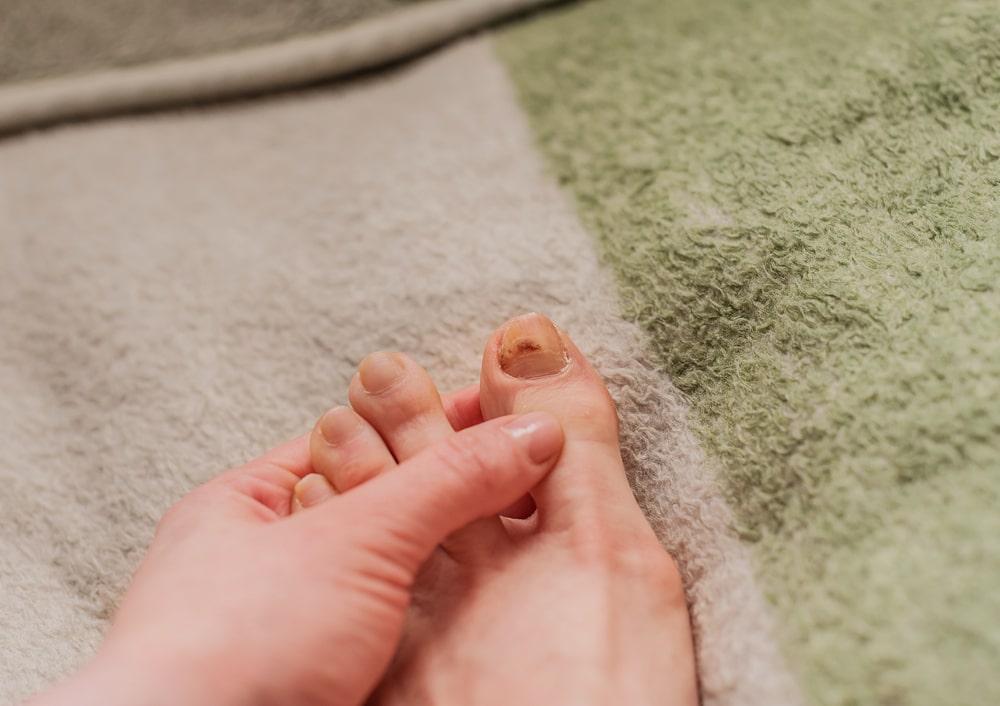 Causes of Early Stage Toenail Fungus