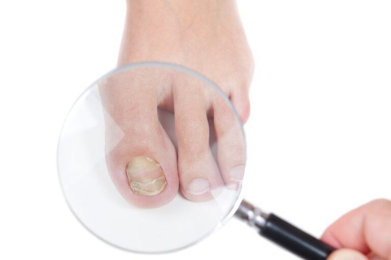 Different Types Of Toenail Fungus (2023) | PureHealth Research