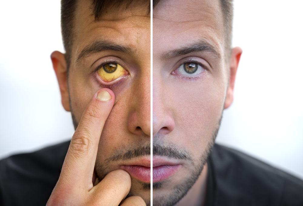 A man experiencing Jaundice