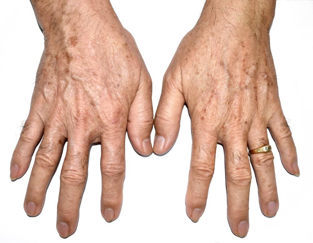 Hands experiencing Skin Changes