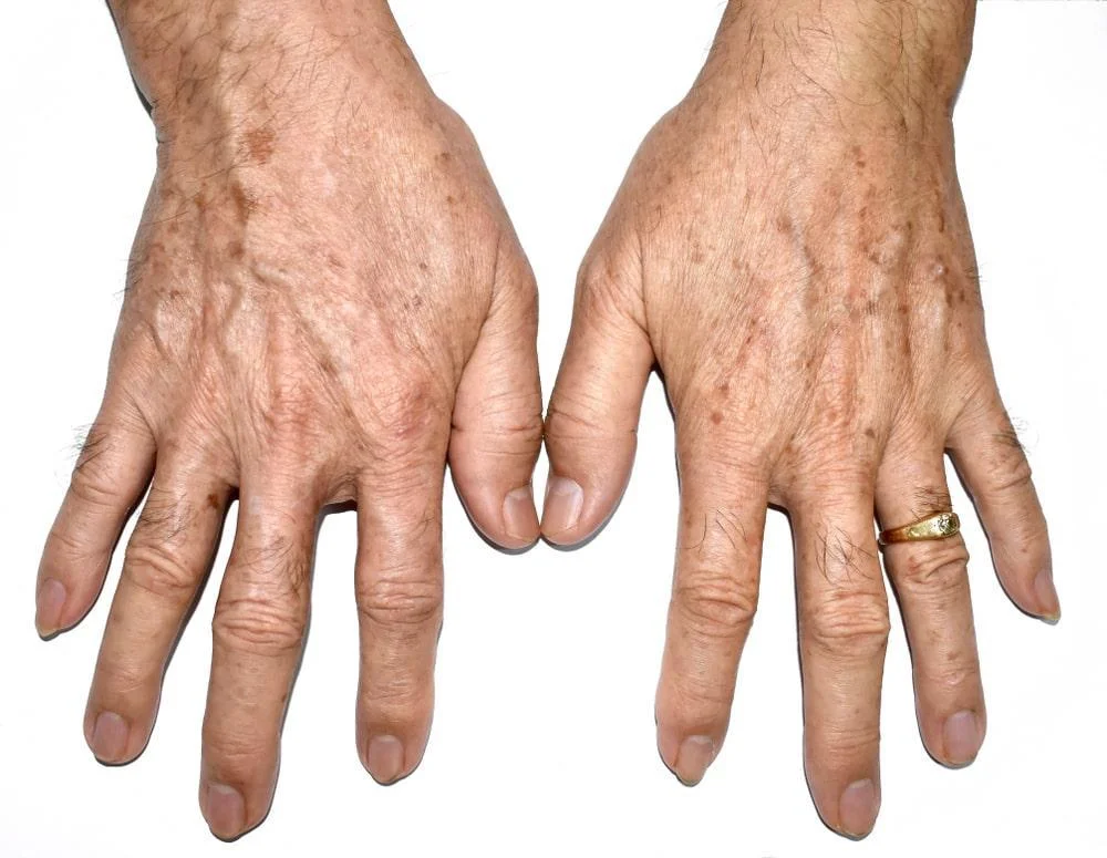 Hands experiencing Skin Changes