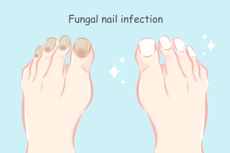 What Causes Toenail Fungus? (2023) PureHealth Research