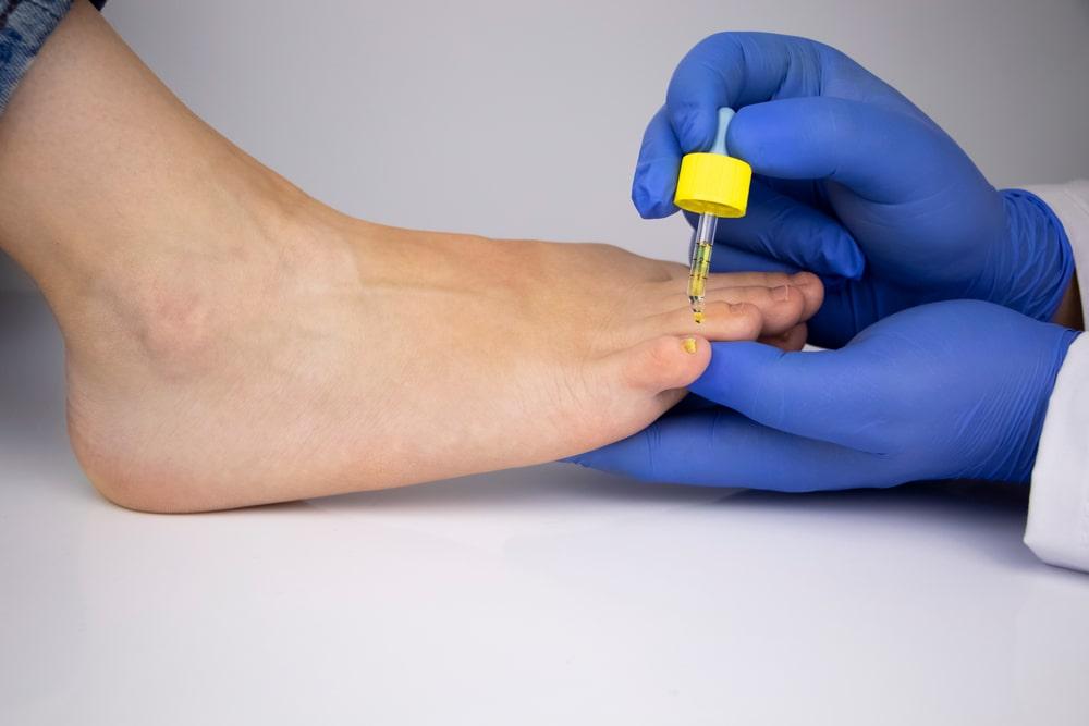 Hands with blue medical gloves treating toenail fungus with OTC oil