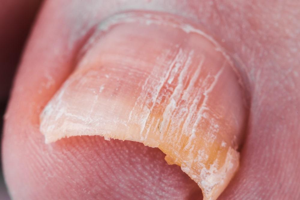 Zoomed in toenail with fungus infection