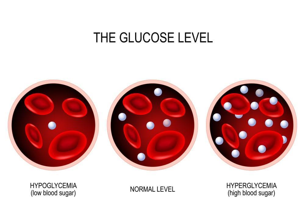 Glucose level stages - normal, hypoglycemia, hyperglycemia