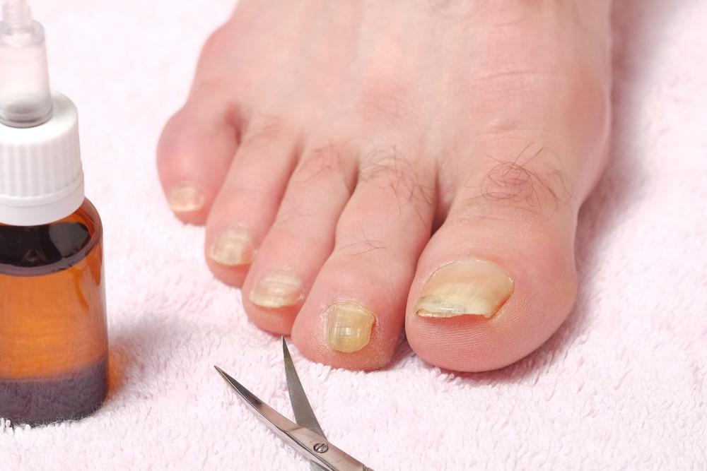 Feet With Toenail Fungus Next to the Scissors and a Bottle Showcasing What Does Toenail Fungus Look Like