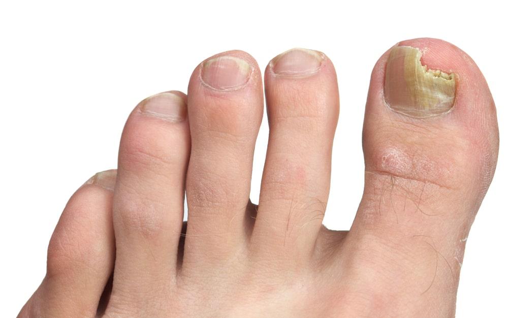 Feet with toenail fungus infection, yellow thumb