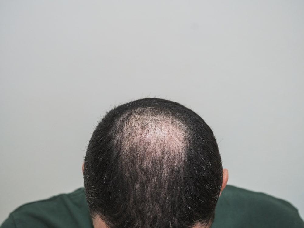 A Man Experiencing Balding at a Crown