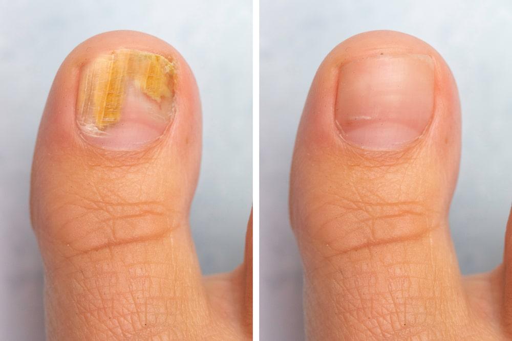 A Close-up of a Fingernail With a Fungus Infection on the Left and Cured One on the Right