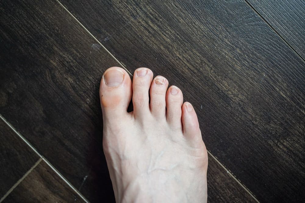 A Man’s Feet in an Early Stage of Toenail Fungus