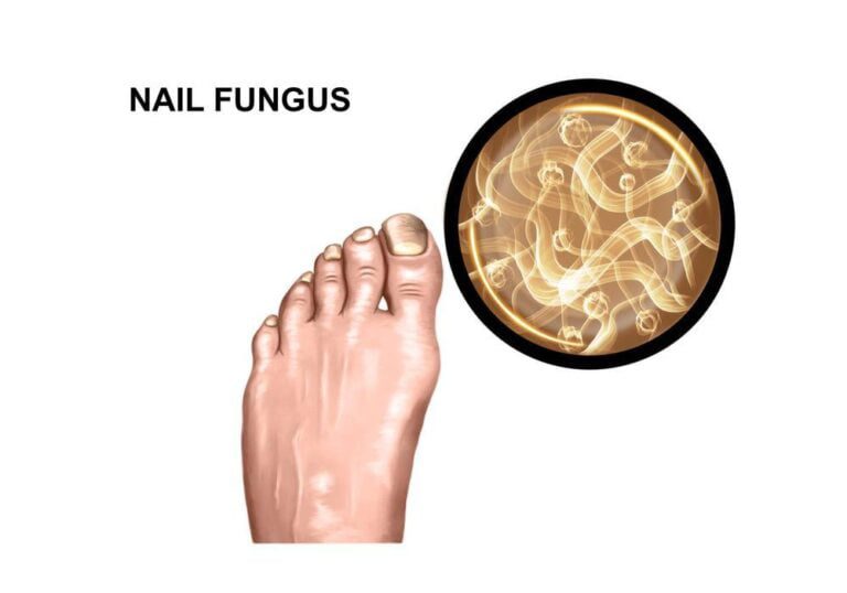 What Causes Toenail Fungus? 11 Reasons PureHealth Research