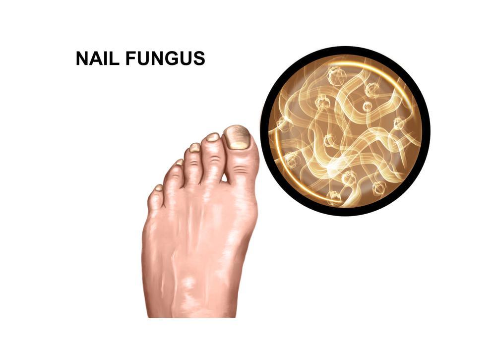 Illustration of feet with nail fungus in a white background