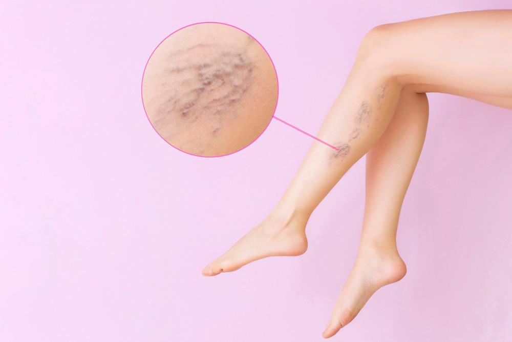 Woman’s Legs Affected by Varicose Veins Before Taking 6 Best Supplements for Varicose Veins