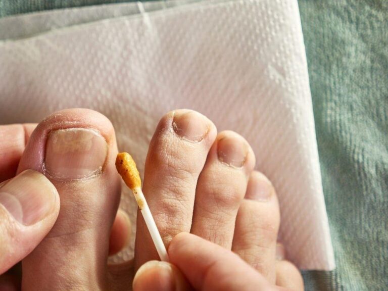 How To Know If Toenail Fungus Is Dying Ultimate Guide Purehealth Research 1335