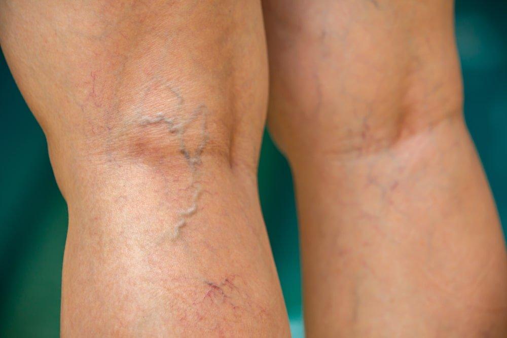 Varicose Veins on the Back of Woman's Knees and Legs 