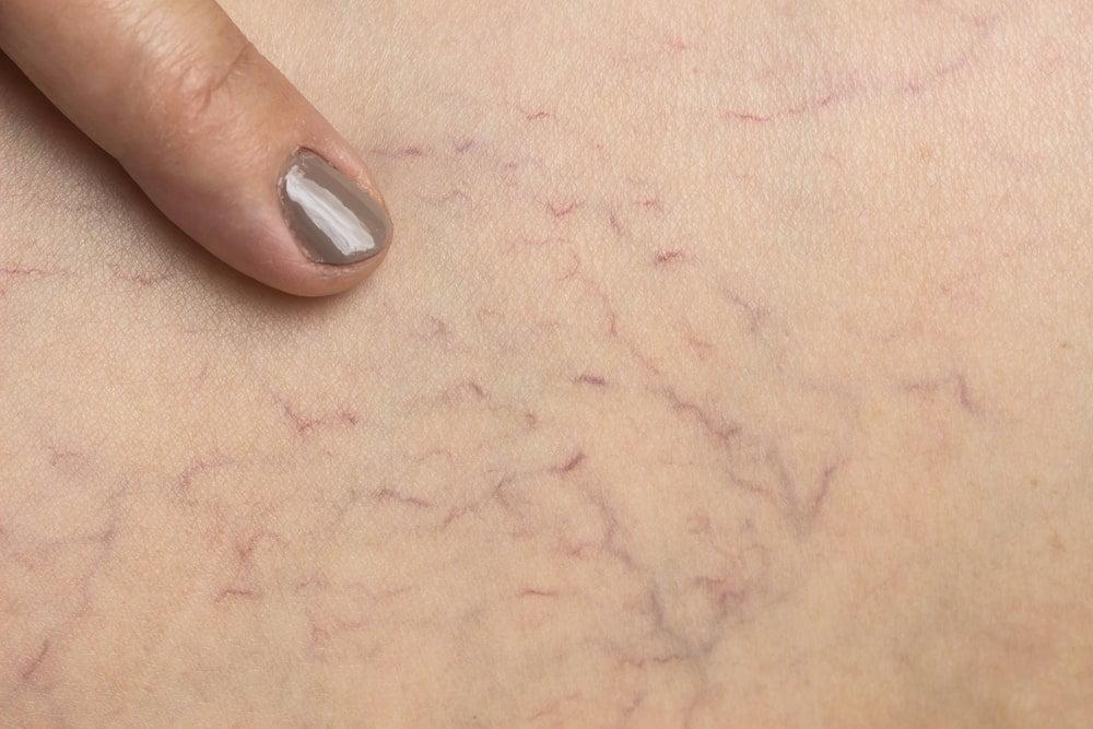 Spider Veins Under Woman’s Skin