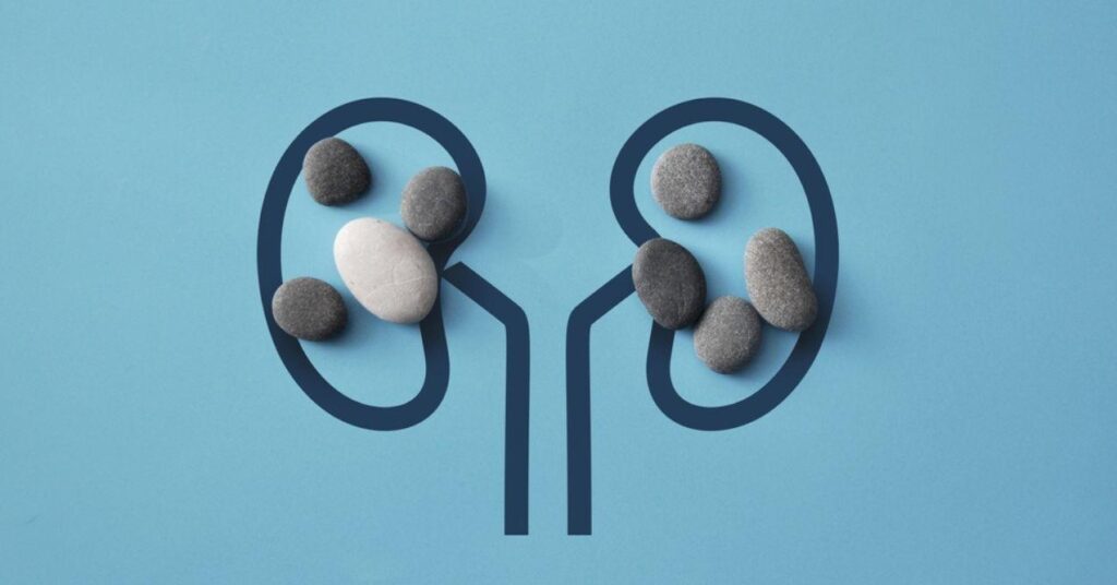 3-worst-alcoholic-drinks-for-kidney-stones-purehealth-research