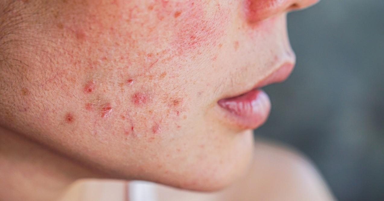 Closeup Acne on Woman’s Face With Rash Skin