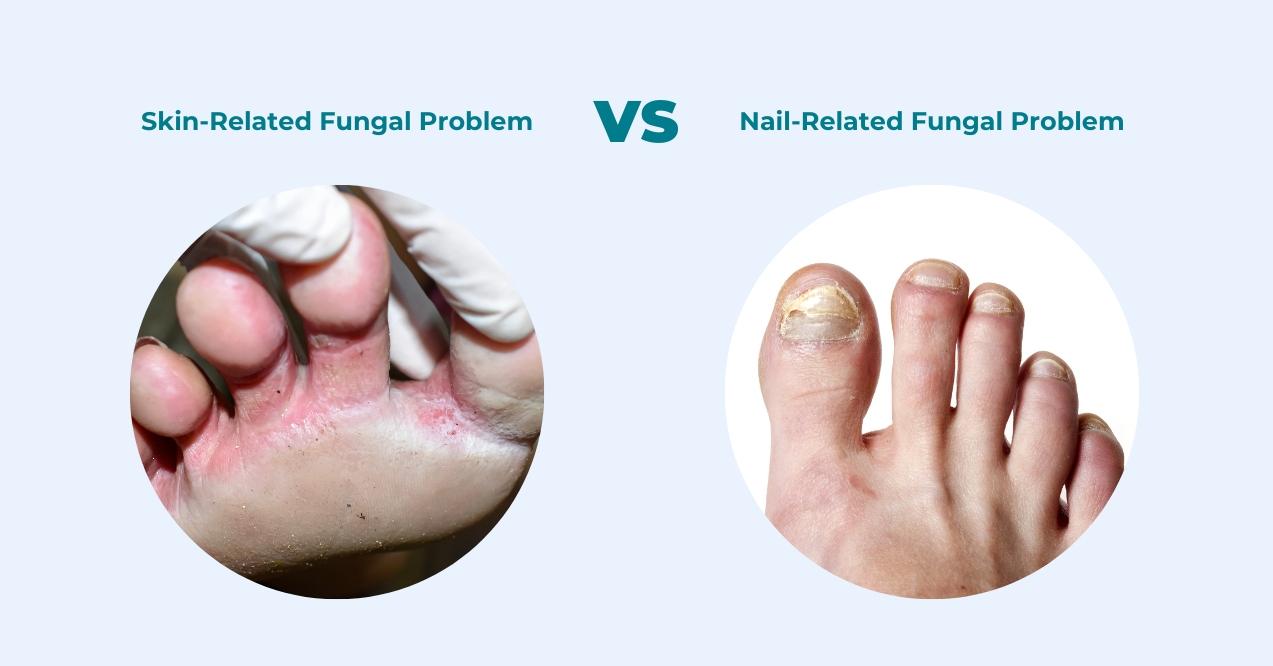 Illustration with two circles showing the difference between skin and nail fungal infections