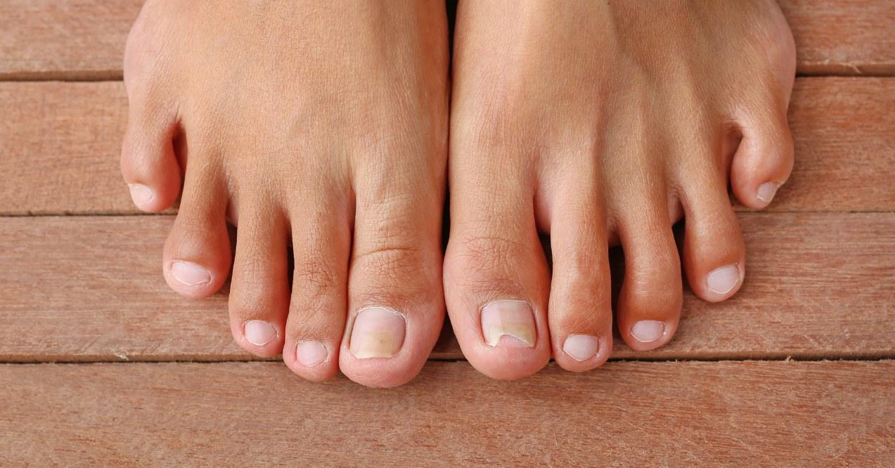 Point to damaged toenail, broken nail, toenail fungus