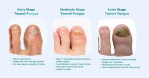 Can You Get a Pedicure if You Have Toenail Fungus? PureHealth Research