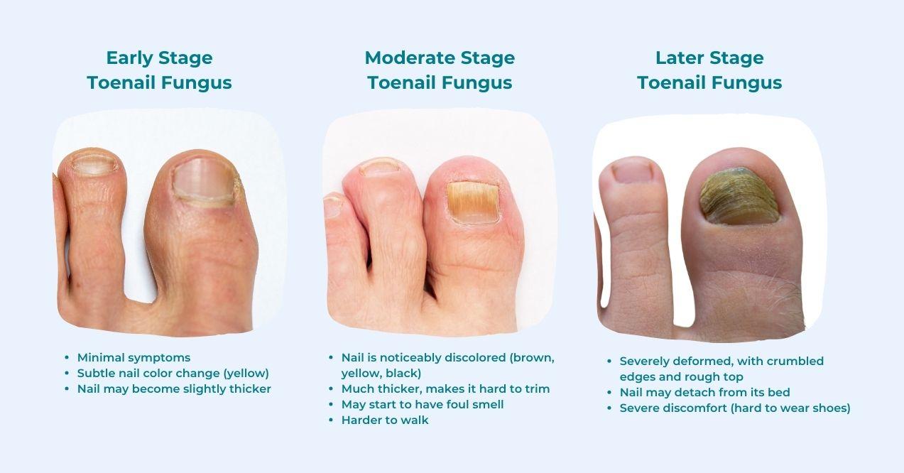 Illustration of three stages of toenail fungus: early, moderate and later stages with the visualization of nails