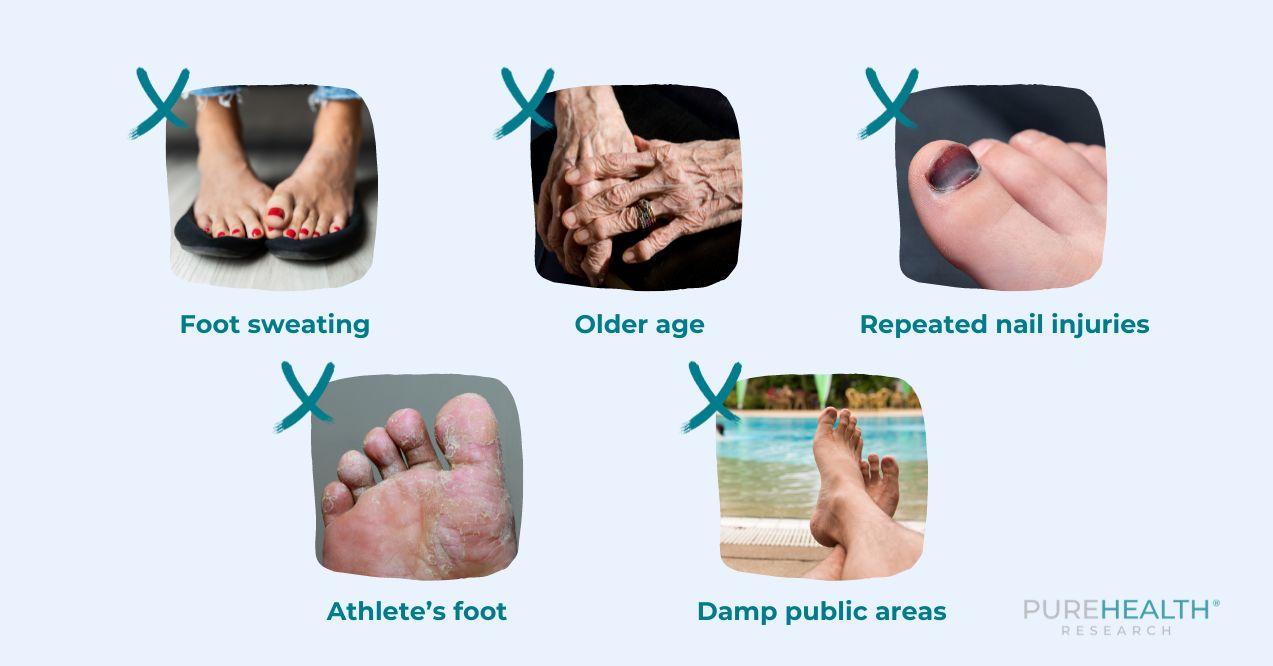 A visual showing five main causes of toenail fungus infections: foot sweating, older age, repeated nail injury, athlete's foot, damp public areas