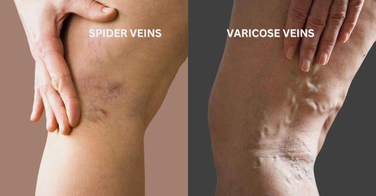 An image comparing visual differences between spider veins and varicose pains. Zoomed in.