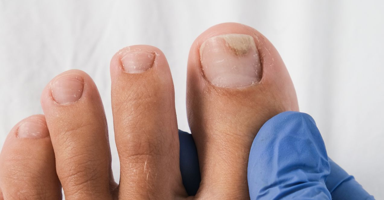 A podologist examines bare foot with onycholysis on a toenail after damaging with tight shoes or using gel-lacquer