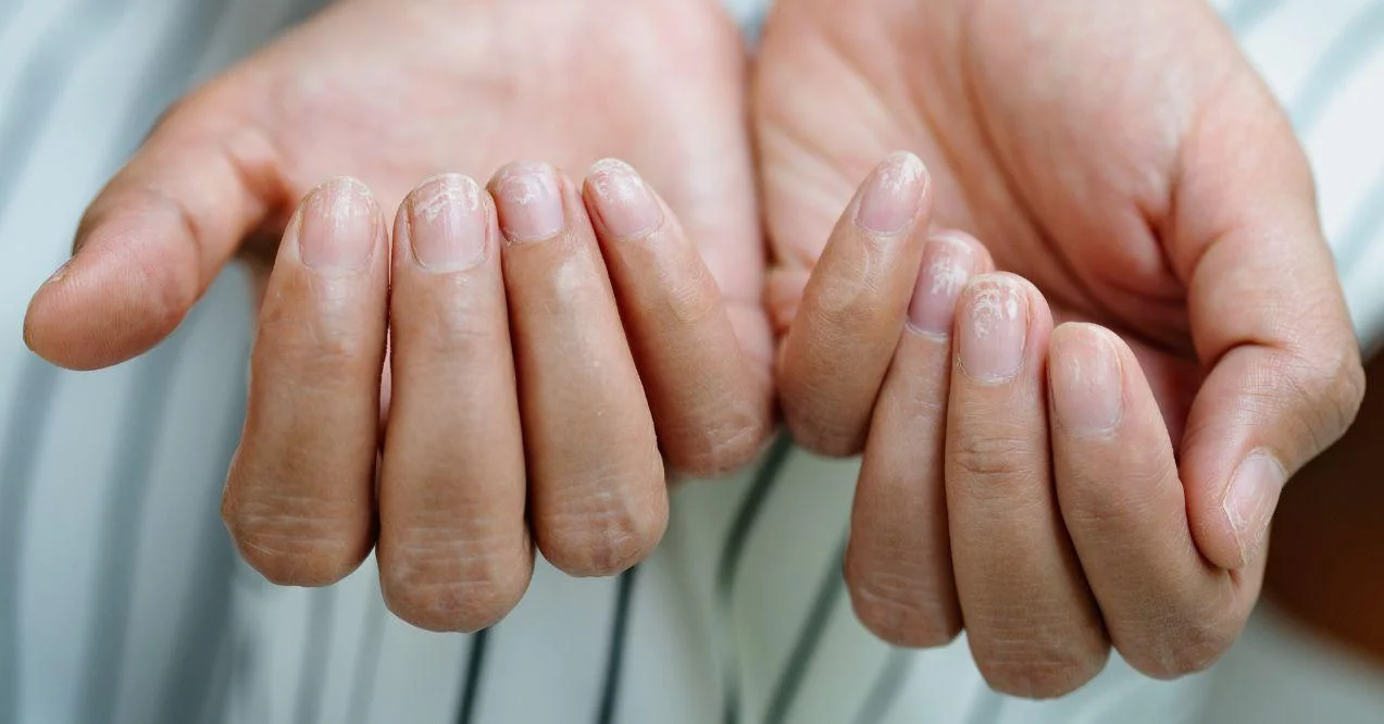 Brittle nails up close. Two hands. Zoomed in.