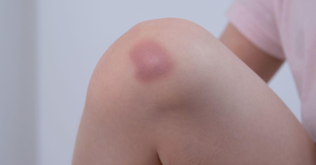 Zoomed in bruise on a knee.