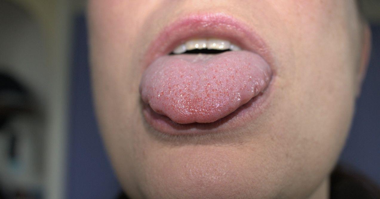Zoomed in swollen tongue.