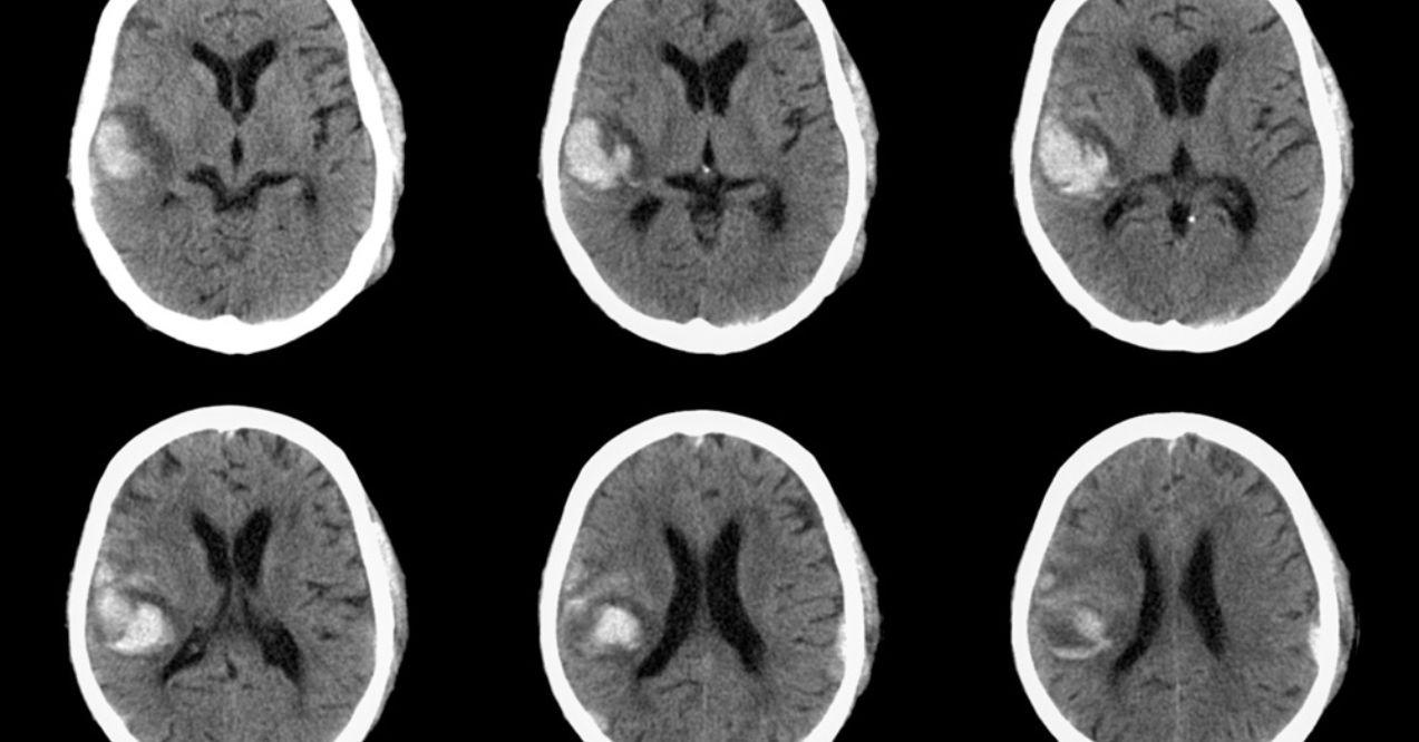 MRI Scan of a Brain Tumor