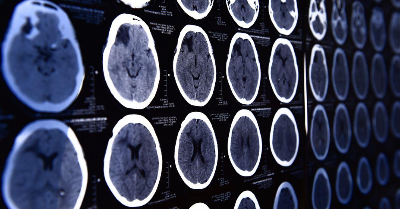 Brain MRI Scan Showcasing Neurological Diseases