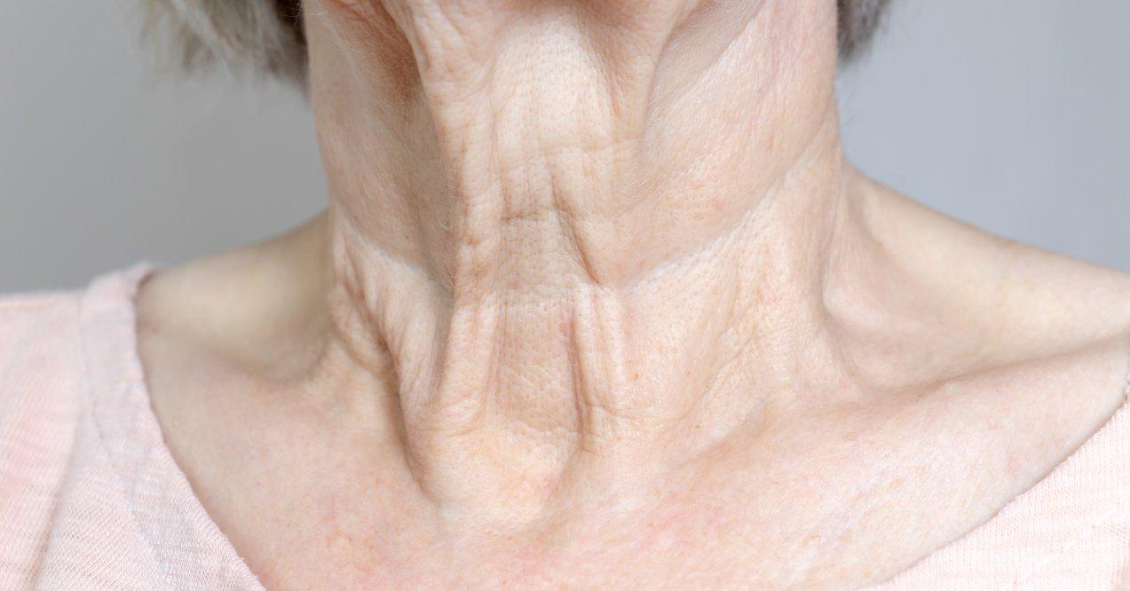 Flabby wrinkled excess skin on a senior woman's neck