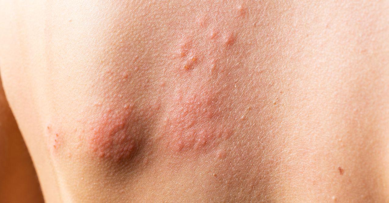 Skin rashes appeared on the back due to allergies