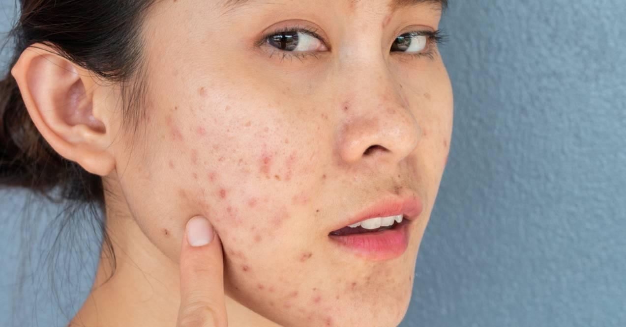 Woman is showing her acne with a thumb