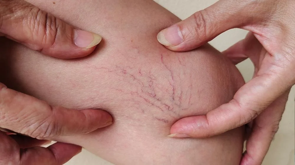 Spider veins on the leg of a woman
