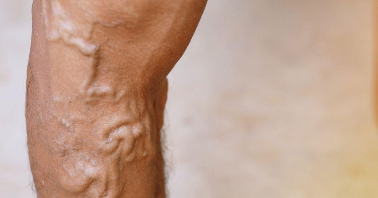 The severity of the varicose veins ranges from the tiny capillaries