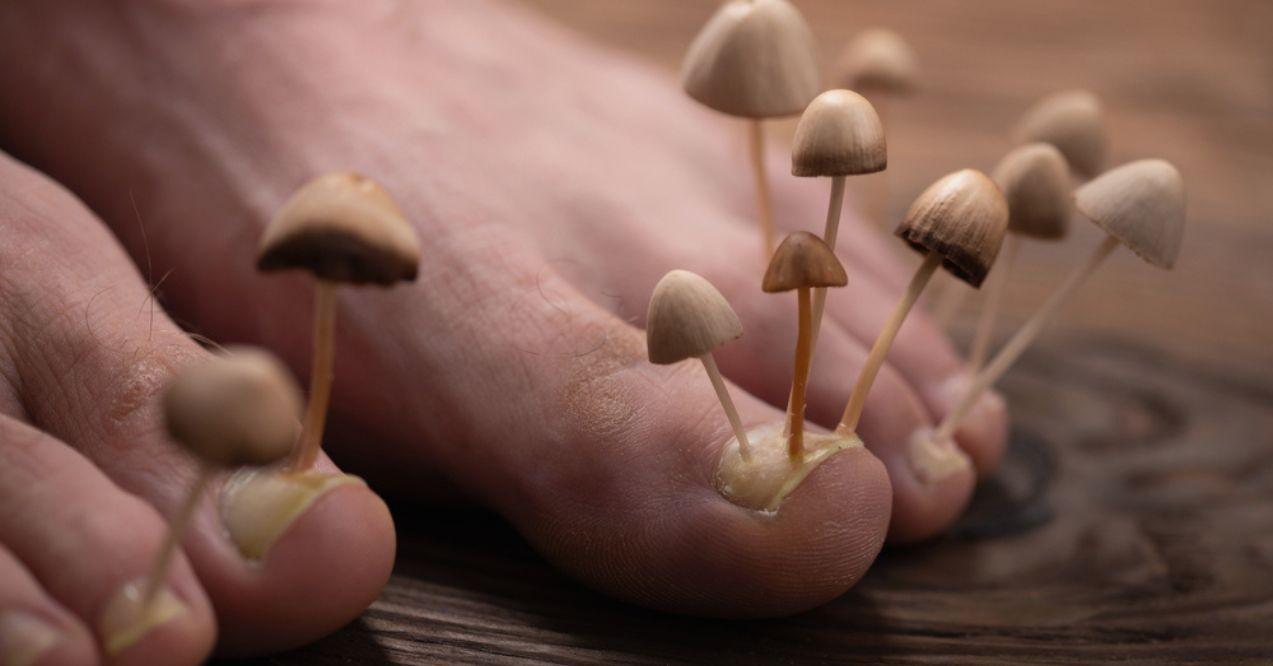 A Person’s Foot With Tiny Mushrooms on It Who Is Unaware on How to Know if Toenail Fungus is Dying