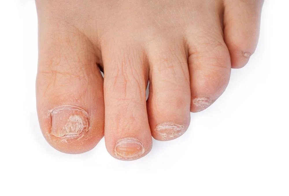 Toenail fungus changes in texture