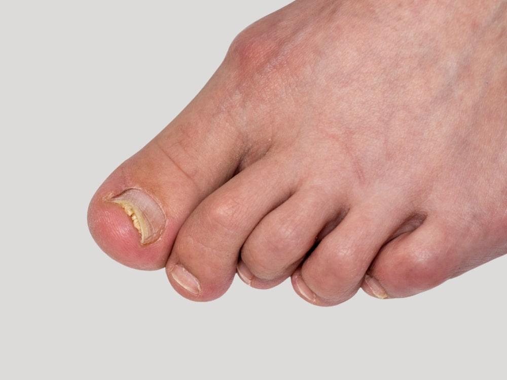 Toenail with fungus lifted from the nail bed