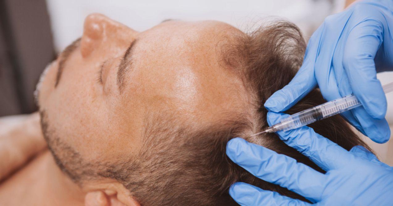 Dermatologist doing scalp injections for a male client